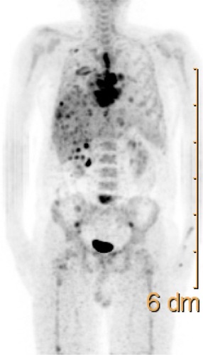 Figure 3 Maximum intensity projection image 18F-FDG PET-CT shows multiple distant metastasis in the lung, liver and bones.