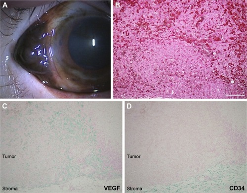 Figure 2 Another representative case of conjunctival melanoma in an 84-year-old female.