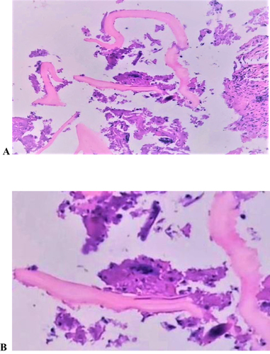Figure 3 H and E stained histologic sections from chest wall biopsy 10x (A) and 20x (B) show multiple fragments of acellular laminated fibrous tissue with intense foreign body-type giant cell granuloma accompanied by a few small mature lymphocytes, predominant chronic mononuclear inflammatory cells on satellite granular necrotic debris background.