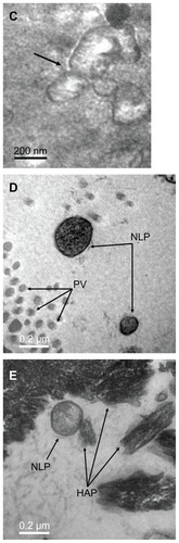 Figure 1 Transmission electron micrograph of calcifying nanoparticles. (A) Calcifying nanoparticles between 50 nm to 500 nm in diameter showing different electron-dense shells in calcified placental tissues. (B) Nucleic acid-like materials distributed within the individual calcifying nanoparticles in the extracellular matrix. (C) A calcifying nanoparticle self-divided into two. (D) Calcifying nanoparticles with thin shells exiting placental villus. (E) Single calcifying nanoparticles among hydroxyapatite crystals in calcified placental tissues.Note: Bar indicates magnification of 200 nm.