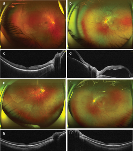 Figure 2. Patient 5 was diagnosed as bilateral posterior uveitis resembling Harada disease 14 days after first dose of inactivated COVID vaccine. (a and b) Fundus photos of right and left eye at the first presentation, which showed serous retinal detachment in both eyes. The left eye was more severe than the right eye. (c and d) optical coherence tomography (OCT) of right and left eye. Macula was involved in the left eye. Intravitreal dexamethasone implantations were performed and the bilateral episode completely resolved without recurrence. (e and f) Fundus photos after treatment. (g and h) OCT of right eye and left eye respectively after treatment.