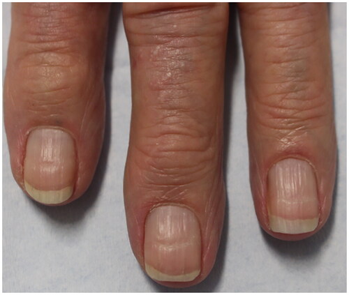 Figure 5. 93-year-old female with bullous pemphigoid presented with Beau’s lines on all fingernails at even intervals coinciding with her monthly IVIG treatments [Citation23].