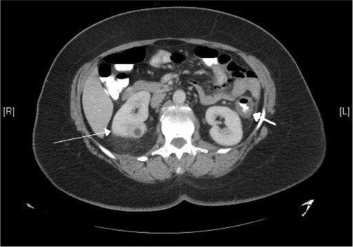 Fig. 1 Computed tomography scan of the abdomen (axial view) showing thickening of the colon wall (short thick arrow, on the left) as well as right kidney mass (long thin arrow).