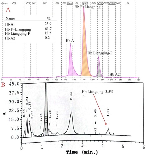 Figure 3. The Hb analysis results of the newborn in F2. CE showed a 12.2% variant peak in zone 5 (A), and HPLC displayed a low value peak (3.5%) in the S-window (B).