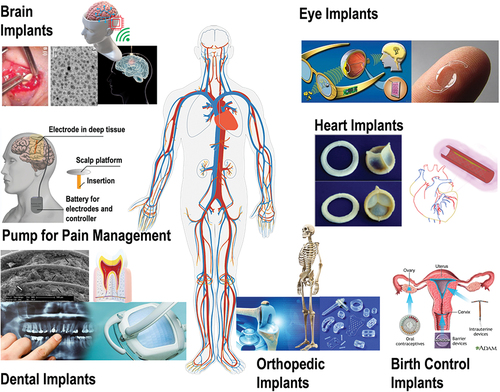 Figure 1. Biodegradable and non-biodegradable implants for drug delivery to manage disease conditions in humans. The ocular and brain inserts are useful for the sustained drug release, while drug-loaded stents have been utilized for cardiac disease management. The drug-loaded implants have demonstrated birth control application and in orthopedic problems for pain management [Citation14–17].