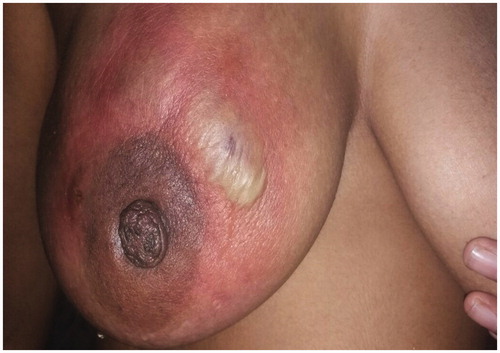 Figure 3. Increased inflamation with superficial abscess formation after 7 days of ATT.