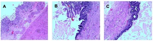 Figure 5 The pathological report confirmed the existence of gastric mucosa in the inner surface of the cysts.