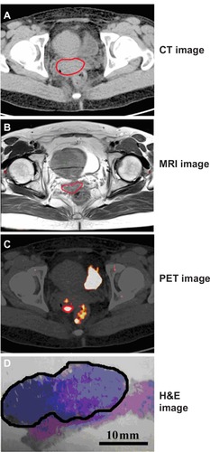 Figure 3 (A–D) One representative case (case 4) on CT image, MRI, PET image, and H&E image of surgical pathological specimen of cervical cancer. The tumor border is delineated by the red lines on CT (A), MRI (B), and PET (C), and by the black line on whole-mount section of tumor (D).