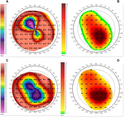 Figure 1 Sample corneal topography with preoperative and post-PRK axial map of a 39 years old woman included in the cohort. (A) Preoperative (T0) corneal axial map with a post-PK high irregular astigmatism. Preoperative CDVA was 0.18 LogMAR, spherical equivalent (SEQ) was −7D, refractive astigmatism (SRAST) was 11D and keratometric astigmatism (SimK) was 12.1D. (B) Expected ablation depth map with planned customized trans-epithelial PRK treatment: the calculated ablation in the optical zone is 121µm. (C) Postoperative corneal axial map at 12 months (T3) after PRK with reduction of topographic astigmatism and regularization of corneal morphology - especially in the central area. (D) Achieved ablation depth map at 12 months (T3) after PRK. Postoperative CDVA was 0.05 LogMar, spherical equivalent (SEQ) was −1D, refractive astigmatism (SRAST) was 6D and keratometric astigmatism (SimK) was 7.75D. Compared to expected ablation depth map, no substantial differences are highlighted. This is a sign that the ablation was conducted as planned.