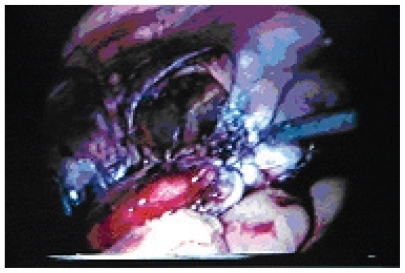Figure 3 Tubularized Boari flap being anastomosed to the ureter.