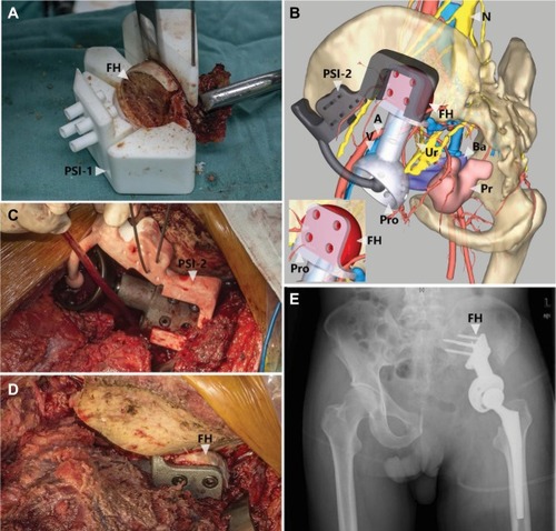 Figure 3 3D-multimodality image-based virtual surgical planning and 3D-printed PSI helped the reconstruction of the pelvis after tumor resection.Notes: (A) An intraoperative photo showing PSI-guided preparation of FH graft, which was used later to fill the gaps between the prosthesis and the ilium. The PSI-1 also facilitated the screw fixation by predrilling holes in the FH graft, combined with PSI-2 in (B). (B) 3D-multimodality image-based virtual surgical planning showing the reconstruction with PSI-2 and the worked FH. PSI-2 was also used to indicate the simulated proper rotation center of the FH. The picture in the left bottom illustrating the gap, between the prosthesis and the ilium, was filled by the FH graft suitably. (C–E) Intraoperative photos and postoperative plain film showing satisfactory reproduction of the virtual surgical planning.Abbreviations: A, artery; Ba, bladder; FH, femoral head; N, nerve; Pro, prosthesis; Pr, prostate; PSI, patient-specific instruments; Ur, ureter; V, vein.