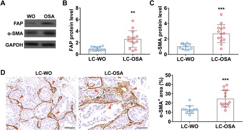 Figure 1. Cancer-associated fibroblasts are enriched in tumor of lung adenocarcinoma patients with OSA. The protein level of FAP (A and B) and α-SMA (A and C) in tumors from lung adenocarcinoma patients with OSA (n = 14) or without OSA (WO, n = 11). (D) The area percentage of cancer-associated fibroblast (α-SMA+) (indicated by red arrows) in tumors from lung adenocarcinoma patients with (OSA, n = 14) or without OSA (WO, n = 11).