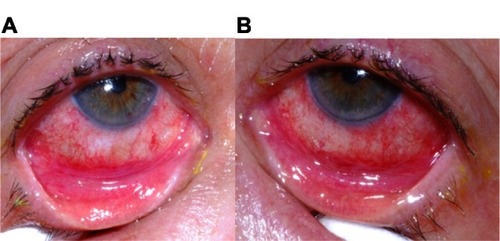 Figure 2 Patient’s ophthalmic appearance at 2.5 days (60 hours) after disease onset. (A) The right eye demonstrates evidence of marked conjunctival injection. The right eye also shows defects in the bulbar conjunctival epithelium and epithelial sloughing of the eyelid margin. (B) The left eye shows similarly severe ophthalmic involvement.