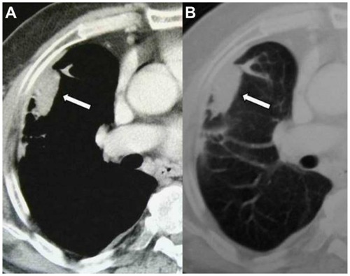 Figure 1 Axial computed tomography images of the right lung in the (A) mediastinal and (B) pulmonary window demonstrate the pleural mass corresponding to mesothelioma (initial examination). antigen, and thyroid transcription factor-1. Metastasis in the adrenal gland remained stable. Bone scans and brain CT scans were not pathological. No confirmation was made on the malignancy of the adrenal gland. Pleural thickness at diagnosis was 90 mm × 20 mm, and 40 mm × 15 mm at the end of the first-line treatment. Follow-up has continued for 9 years; the disease is stable without any disease progression.