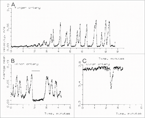 Figure 4. (A) Blood velocity in a finger artery in a 29-year-old male subject, measured over a period when ambient temperature was being increased. (B) Blood velocity in the right ulnar artery in a 26-year-old male subject. The subject's opposite hand was submerged in cold water for 40 s. (C) Blood velocity in the right ulnar artery in a 27-year-old male subject. The vasoconstriction was caused by the sight of a girl in a neighboring tropical greenhouse. (From Thoresen and WalløeCitation14). © Blackwell Publishing. Reproduced by permission of Blackwell Publishing. Permission to reuse must be obtained from the rightsholder.