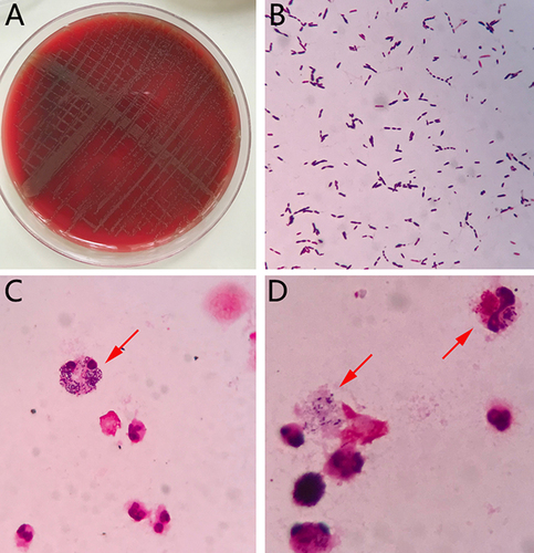 Figure 1 (A) Culture of the first urine specimen on blood plate; (B) Gram stain result of the first cultured strain; (C and D) phenomenon of polymorphonuclear Leukocyte phagocytosis under microscope. Red arrow point to the phenomenon of polymorphonuclear Leukocyte phagocytosis.