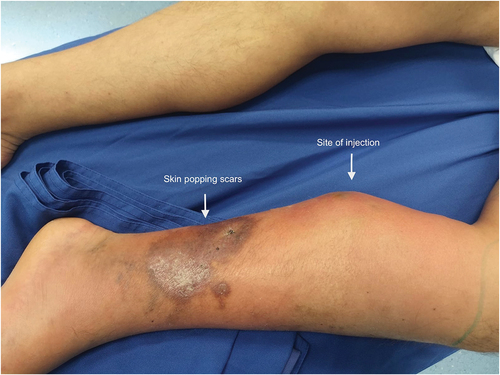 Figure 1. Left calf of a IDU patient: evidence of swelling and ecchymosis in the site of cocaine injection; hyperpigmentation and chronic scarring (skin popping scars) in the distal leg area.