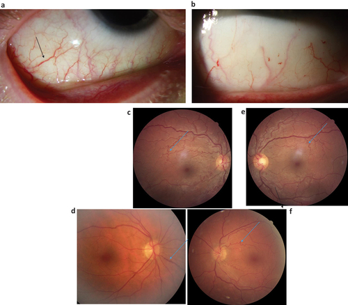 Figure 4. a–f. Photos showing torturous and dilated vessels in the conjunctivae (Figure 4a,b) and in the ocular fundii (Figure 4c-f) in different patients with Fabry.
