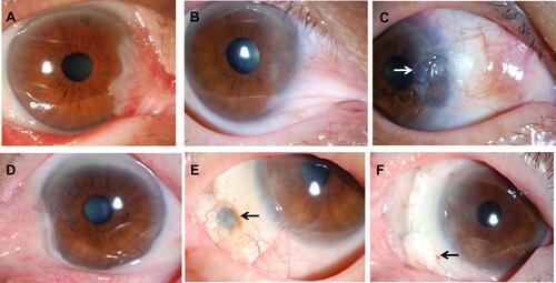Figure 3 Preoperative and postoperative appearances. Upper column, Case 1 and lower column, Case 2. (A) Case 1. Before excision of a recurrent pterygium combined with application of mitomycin C, double amniotic membrane transplantation, and a large conjunctival flap. (B) Before the surgery. (C) At 5.6 years after the surgery. Symblepharon was released and the center of CLA became thinner (arrow), but there has been no recurrence. (D) Case 2. Before the surgery. (E) Scleral stromalysis was observed 6 months after the surgery (arrow). (F) Scleral transplantation was performed for the scleral stromalysis 2 years after the surgery (arrow).