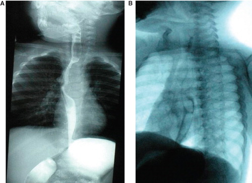 Figure 1. Esophageal fluoroscopy.A:anteroposterior radiograph;B: lateral radiograph.