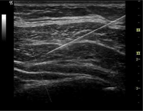 Figure 4 Needle placement in TAP block.