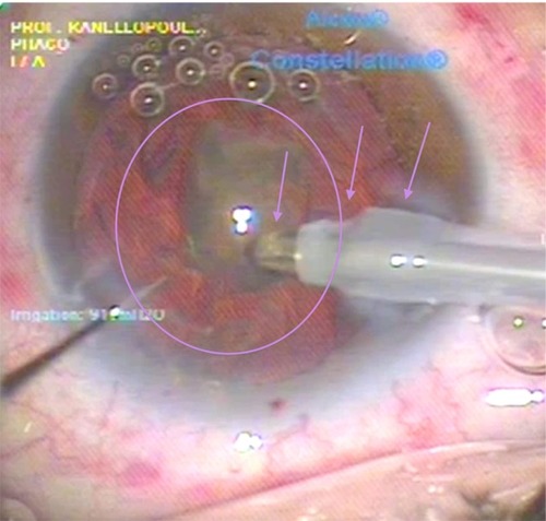 Figure 5 Last step of the nanosecond laser cataract quadrant removal. The last cataract quadrant left within the eye is seen here (purple oval) engaged by the aspiration of the probe (left purple arrow). The middle purple arrow points to one of the two silicone probe sleeve openings providing the coaxial irrigation. Finally, the rightmost purple arrow points to the hydration of the femto-created cornea incision, seen as clouding. This clouding of the incision margins is purely hydration, because this nanosecond laser probe does not emit any heat, as the laser energy is transmitted through fiber optics within the probe and released just at the edge of the probe onto the titanium target within the probe shown in Figure 1.