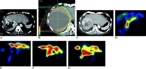 Figure 1.  CT and 99mTc-GSA scintigraphy SPECT images of Case 1. (A) Pre-treatment enhanced CT image with a large nodule occupying almost the entire right lobe of the liver. (B) Dose distribution of the proton beam therapy. The clinical target volume was contoured on the CT images. (C) The enhanced CT image in the arterial phase at six months after proton beam therapy. The enhancement in the arterial phase was diminished, and the surrounding normal liver tissue was enhanced as a sign of radiation hepatitis. Atrophic change in the irradiated normal liver tissue had already started. Ascites appeared around the tumor with no other clinical symptoms of hepatic failure. Before (D), at the end of (E), and 6 (F), and 12 (G) months after proton beam therapy. An uptake defect in liver S6/7, which corresponded to the tumor, was observed before proton beam therapy (D). At the end of the therapy, the extent of this uptake defect was greater because the radiation damage decreased 99mTc-GSA uptake in the irradiated normal liver tissue around the tumor (E). After the therapy, the uptake defect continued to exist, and 99mTc-GSA uptake was high in the left lobe of the liver (E–G). At six months, the compensatory hypertrophy process appeared to be prominent, because 99mTc-GSA uptake of the entire left lobe was homogeneously high (F). At twelve months after proton beam therapy, 99mTc-GSA uptake in the dorsal area of the left lobe had relatively increased (G) and resembled the pre-treatment uptake distribution of the left lobe (D). This finding suggested that the compensatory hypertrophy process had calmed down over the course of one year.