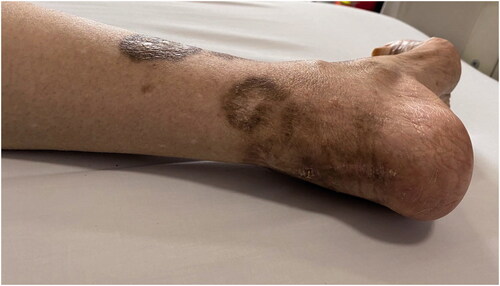 Figure 1. Skin injury. Skin necrosis scars on the foot and heel.