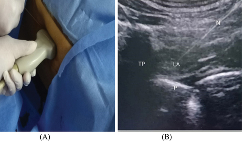 Figure 1. (a): Identification of insertion point 3 cm lateral to the spinous process of (T5-T6). (b): Ultrasound-guided mid-point transverse process to pleura. The local anesthetic injection was made at the midpoint between the posterior border of the transverse process and the pleura (LA; local anesthetic, N; needle).