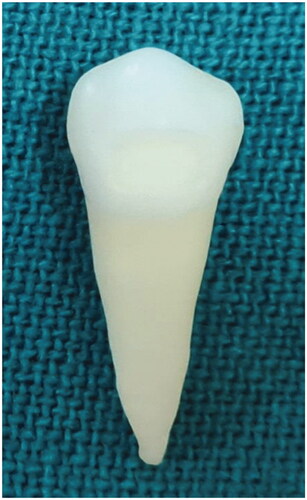 Figure 1. 0 = No dye penetration,1 = dye penetration along the interface to one-third of the cavity depth, 2 = dye penetration along the interface to two-thirds of the cavity wall depth, 3 = dye penetration up to, but not along, the axial wall, and 4 = dye penetration up to and along the axial wall.