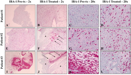 Figure 5. Immunohistochemistry to investigate tumor-associated macrophages (TAMs) was performed on pretreatment (tx) samples as well as untreated and treated tumor samples using antibodies again IBA-1. All samples exhibited variable numbers of readily identifiable IBA-1 positive cells in pretreatment samples (first and third column) as well as untreated tumor samples (not shown). In treated samples, 2/3 patients exhibited prominent IBA-1 positive cells at the treatment interface (arrows) as well as low to medium numbers of IBA-1 positive cells within areas of cell death (asterisks). All IHC samples utilized a red chromogen and hematoxylin counterstain. Magnifications are noted in the figure headings.