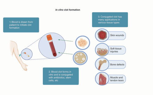Figure 2. Strategy to use autologous blood clots in regenerative medicine.The strategy to use autologous blood clots in regenerative medicine, including: 1. blood preparation after being drawn from patients; 2. blood clot forms in vitro and can be conjugated with others, such as drugs, antibiotics, and stem cells; 3. use the conjugated blood clots to repair these injured tissues, such as skin wounds, soft tissues, bone defects, muscle, and tendon tears.