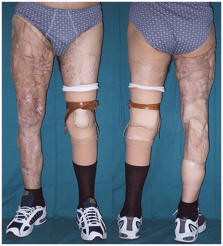 Figure 4. At 10-year follow-up a stable wound closure can be observed following left knee amputation by the use of free fillet of sole of foot flap.