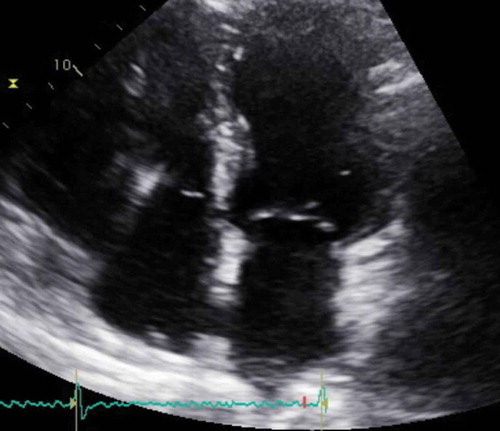 Figure 2. Telemetry strip on the second admission showed nonsustained ventricular tachycardia (NSVT)