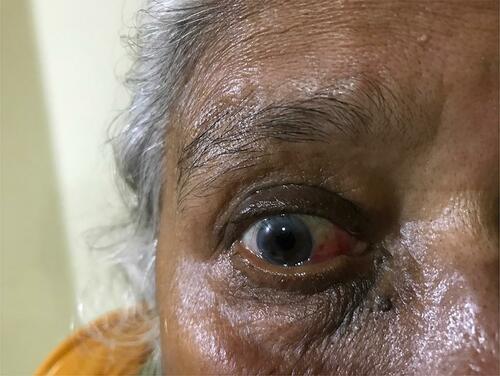 Figure 2 Showing Conjunctivochalasis of the lower lid with subconjunctival hemorrhage.
