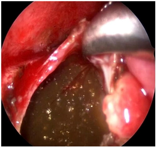 Figure 4. The nasal endoscopic incision of the nasal fundus mucosa shows cholesterol crystals.