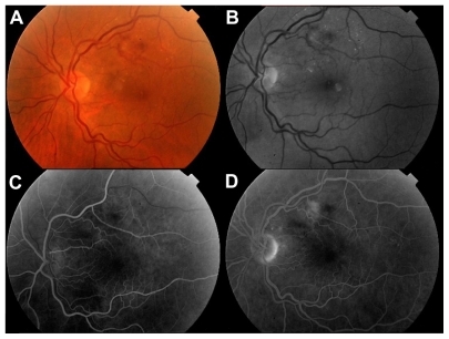 Figure 3 Thirty-nine months later: color fundus photograph of the left eye (A); red-free photograph (B); early (C) and late (D) phase of the fluorescein angiogram showing complete absorption of hemorrhage and resolution of the macroaneurysm leaving focal perivascular fibrosis.