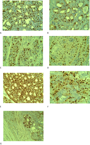 Figure 1 Syndecan-1 immunoexpression in benign and malignant salivary tumors. (A) Score 3 immunoexpression in ductal and myoepithelial cells of pleomorphic adenoma X40. (B) Mixed intra cellular localization in pleomorphic adenoma X40. (C) Mixed intracellular localization in bilayered epithelia of warthin tumor X40. (D) Score 3 expression and mixed intracellular localization in cribriform adenocystic carcinoma X40. (E) Score 3 immunoexpression and mixed localization of both epidermoid and mucous cells in mucoepidermoid carcinoma X40. (F) Capsular invasion of both acinar and ductal cells in acinic cell carcinoma X10. (G) Muscle invasion of acinar and ductal cells in acinic cell carcinoma X10.
