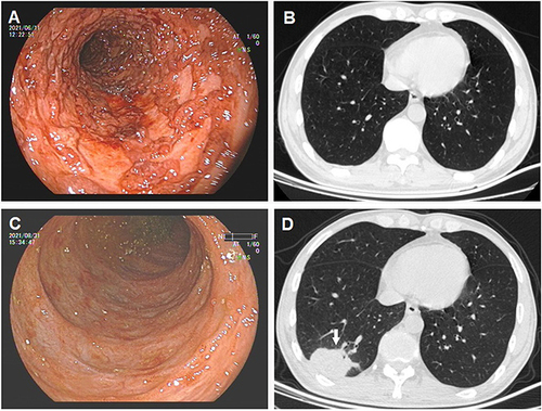 Figure 1 Colonoscopy revealed extensive colitis, with wide mucosal defect and spontaneous bleeding in the sigmoid colon on first admission (A). No obvious abnormality was found on chest CT (B). The colonoscopy (C) and a mass shadow right lower lung lobe (D) after infliximab treatment for four times.