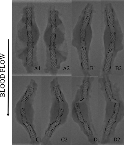 Figure 2.  Different shapes of the stent-grafts (SG) after explantation and fixation in formaline; (A1, A2) representative device of 12 straight SGs; (B1, B2) representative device of 12 slightly SGs; (C1, C2) representative specimen of 4 bent SGs; (D1, D2) sole misaligned device.