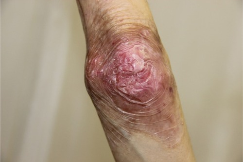 Figure 5 Appearance of lesions on the patient’s elbow on presentation.