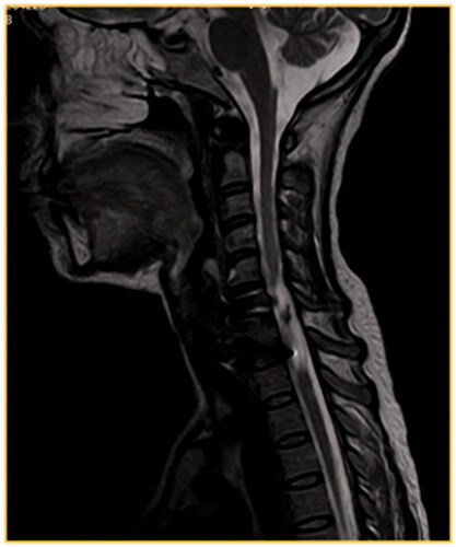 Figure 2. A T2W MRI, a sagittal view of the cervical spine, of a 35-year-old male patient victim of MVA that resulted in fracture C6–C7. The patient had ASIA A score. One year after the initial injury he presented with myelomalacia.