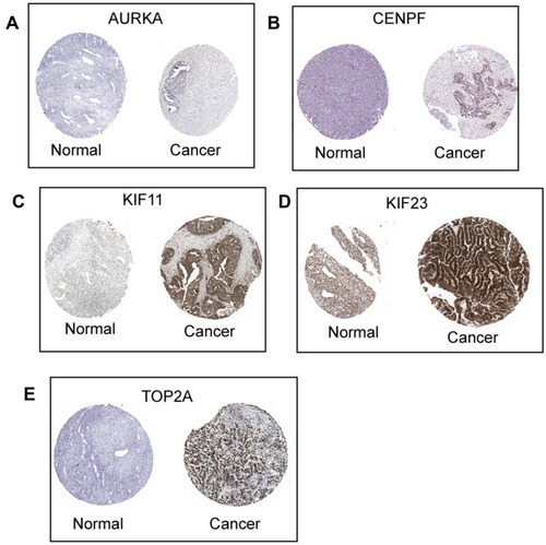 Figure 9 Protein expression of hub genes. The protein expression of AURKA (A), CENPF (B), KIF11 (C), KIF23 (D) and TOP2A (E) in ovarian cancer tissues and normal ovarian tissues were extracted from the Human Protein Atlas (http://www.proteinatlas.org/).