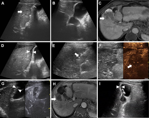 Figure 2 A 52-year-old male with HCC abutting the gallbladder underwent RFA with auxiliary artificial ascites. (A and C) Conventional ultrasound and contrast-enhanced MR image indicated a HCC lesion located in segment V abutting the gallbladder with a maximum diameter of 15 mm (white arrow). (A and B) Gallbladder stones were found on ultrasound images and the thickness of gallbladder wall was 4 mm. (D) Artificial ascites (white triangle) were employed to isolate the lesion and gallbladder before radiofrequency ablation. (E) The electrode (white arrow) was inserted parallel to the gallbladder wall. (F) After 4 ablation cycles, contrast-enhanced ultrasound showed that the index tumor had been completely ablated (white arrow). (G) One day after ablation, the thickness of the gallbladder wall increased to 7 mm (white triangle). (H) Contrast-enhanced MR one month after the ablation procedure confirmed the complete ablation of the index tumor (white arrow). (I) The thickness of gallbladder wall was restored to 4 mm after 5 months on conventional ultrasound image (white triangle).