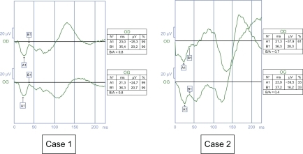 Figure 6 Case 1. Negative profile and b-wave amplitude is 20.2 μV on the right eye, 20.7 μV in the left eye, in the range of those of incomplete congenital night stationary blindness. Case 2. Negative profile and b wave amplitude is 16.2 μV and on the left eye, and 32.1 μV on the right eye but in the range of complete congenital night stationary blindness.