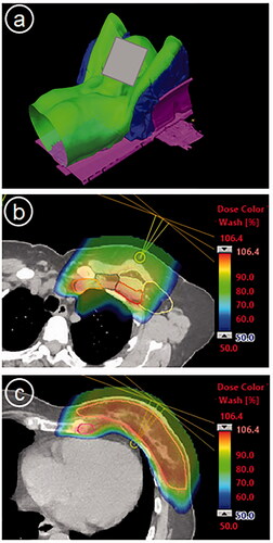 Figure 1. (a) The patient (green) in the vacuum cushion fixation (blue) in the breast board (pink). (b and c) Two CT slices from the same patient and treatment plan showing CTV delineations with dose color wash ranging from 50% to 106.4% of prescribed dose. Note that level 1 lymph nodes (yellow delineation) were not a target.
