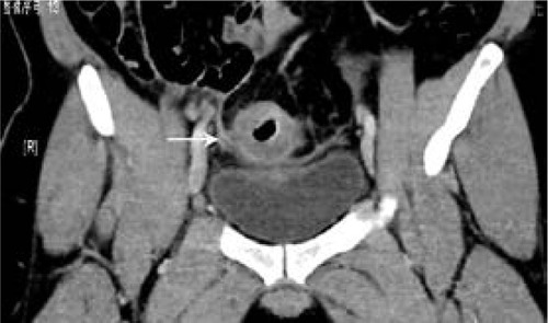 Figure 4 Computed tomography scan of 32-year-old man with signet-ring cell carcinoma of the sigmoideum.