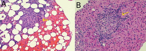 Figure 3. Non caseating granulomas seen in bone biopsy (a) and liver biopsy (b).