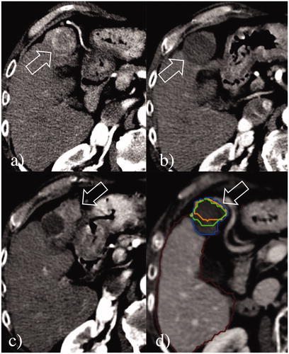 Figure 3. Local tumor progression post-RF ablation from incomplete treatment. (a) A 3.3 cm HCC at S4 (arrow) was ablated with a single insertion of a 3 cm exposed tip RF electrode in 6 min with 1600 mA current. (b) At 24-h CT, the dimensions of the necrosis volume achieved were 3.5 × 3.3 × 3.5 cm. (c) Although the treatment seemed to be complete, at 9-month follow-up CT, a large region of local tumor progression was noted in the anterior portion of the volume of necrosis (arrows). (d) Retrospective assessment of the pre- and post-ablation CT scans non-rigidly co-registered by Ablation-fit software (RAW s.r.l., Milan, Italy) showed that a small portion (15.4%) of the 5-mm ablative margin (green line) was not achieved in the anteromedial part of the HCC, suggesting incomplete treatment was due to an initial technical failure from sub-optimal electrode placement and ablation coverage. The margins of the volume of necrosis (blue line), of the HCC (orange line), and the ablative margin are exactly overlapping.