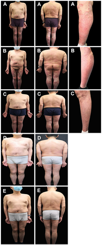 Figure 4 Secukinumab treatment photographs. (A) At the beginning of secukinumab treatment (Erythema, plaque and thin scale are widely distributed on the trunk and extremities), (B) at the second week of secukinumab treatment (The erythema color fades, the plaque becomes thinner, and the scale decreases), (C) at the eighth week of secukinumab treatment (The skin rash on the trunk and upper limbs has basically subsided, and the lower limbs are widely distributed with light erythema, plaque and scales), (D) at the 29th week of secukinumab treatment (The rash is completely cleared) and (E) at the 34th week of secukinumab treatment (The rash is completely cleared).